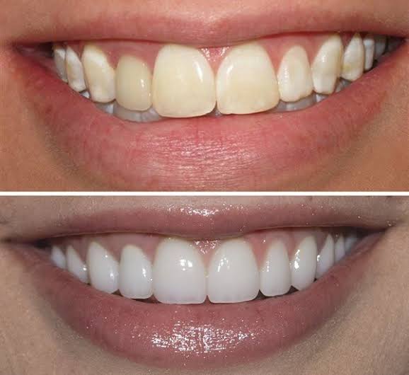 Laser Dentistry Singapore